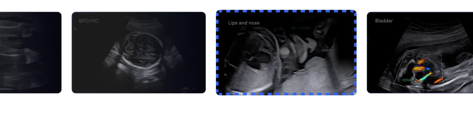 prenatal-ultrasound-images